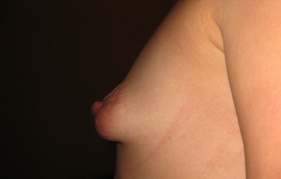Тубулярная грудь - показание для маммопластики имплантами
