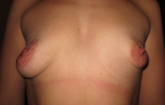 Косметический дефект груди - показание для маммопластики имплантами